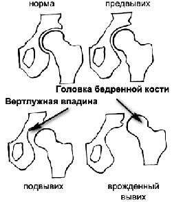  Дисплазия тазобедренных суставов 